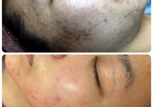 Điều trị mụn bằng IMAGE SKIN CARE